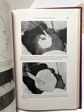 Facial Prosthesis By Arthur Bulbulian 1st Edition Hardback 1945 W. B. Saunders 5.jpg