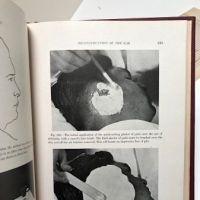 Facial Prosthesis By Arthur Bulbulian 1st Edition Hardback 1945 W. B. Saunders 5.jpg