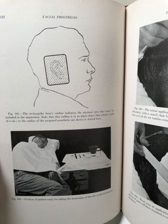 Facial Prosthesis By Arthur Bulbulian 1st Edition Hardback 1945 W. B. Saunders 6.jpg