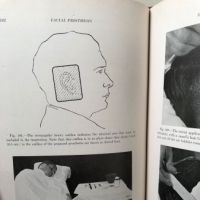 Facial Prosthesis By Arthur Bulbulian 1st Edition Hardback 1945 W. B. Saunders 6.jpg