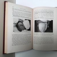 Facial Prosthesis By Arthur Bulbulian 1st Edition Hardback 1945 W. B. Saunders 9.jpg